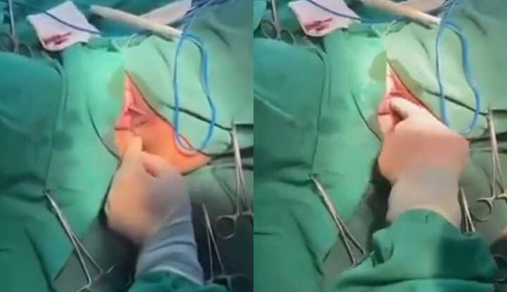 Shaanxi University of Chinese Medicine Affiliated Hospital Live Streams Gynecological Surgery, Exposes Patient Privacy, Full Uncensored Broadcast Draws Tens of Thousands of Viewers! 1